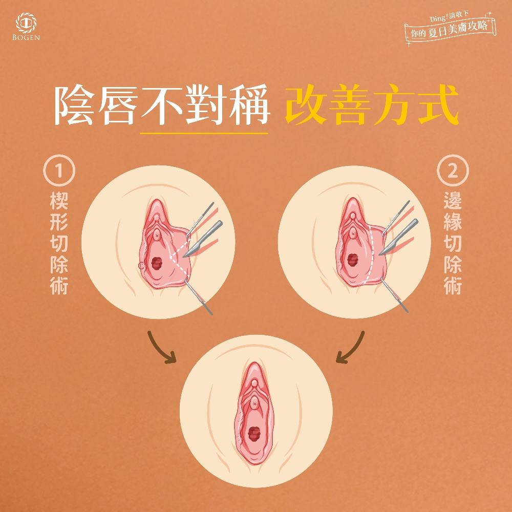 陰唇不對稱手術,陰唇不對稱改善方式,博恩妍